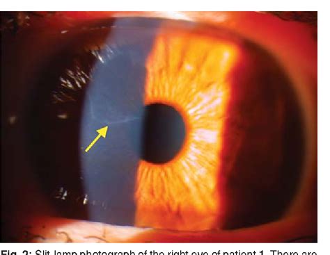 32 Map Dot Corneal Dystrophy Maps Database Source