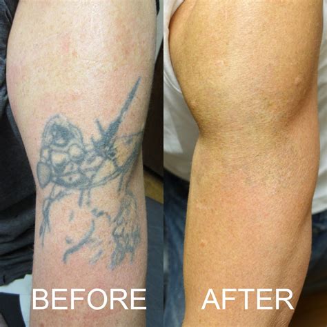 49 Curated Laser Tattoo Removal Ideas By Claritymedspa Mopar Laser