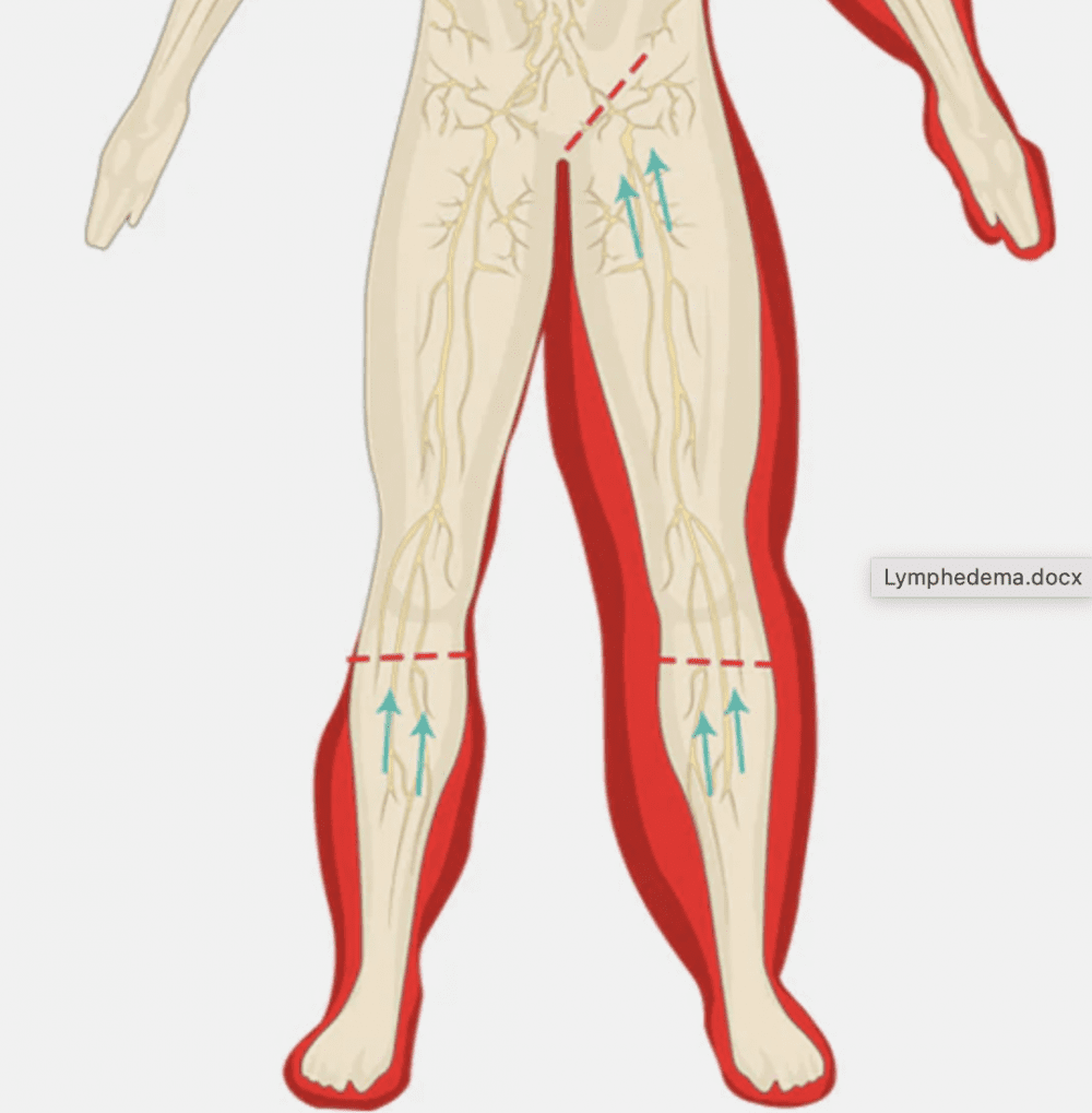 Abdominal Lymphedema And Swelling In The Stomach Treatment By A