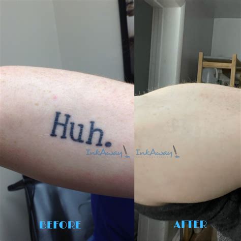 Before And After Photos Inkaway Laser Tattoo Removal