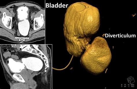 Bladder Diverticulum Causes Symptoms Diagnosis And Management