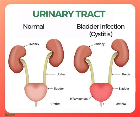 Bladder Infection Cystitis Symptoms Causes And Natural Remedies