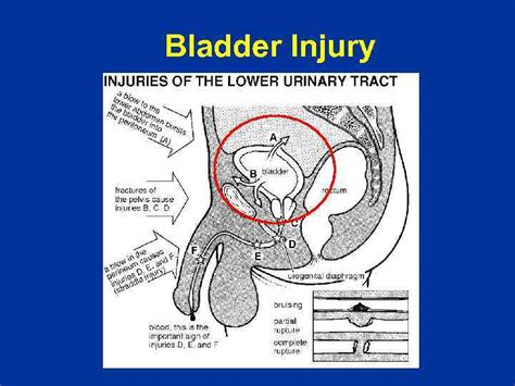 Bladder Trauma Causes Signs And Treatment