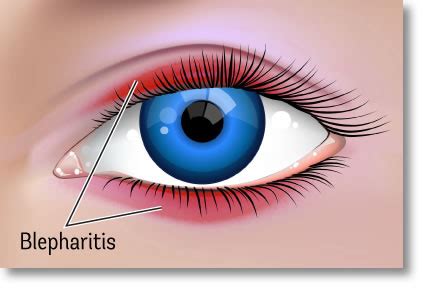 Blepharitis Kindred Optics