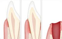 Consequences Of Periodontitis Read All Info At Periodontal Health Com