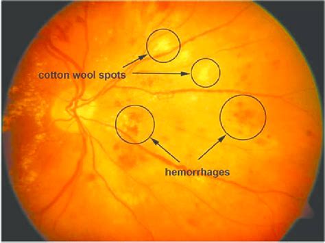 Cotton Wool Spots Retina