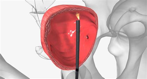 Cystoscope Exploration It Can Be Used To Look For Causes Of Signs Or