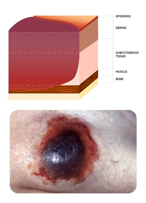 Deep Tissue Pressure Injury