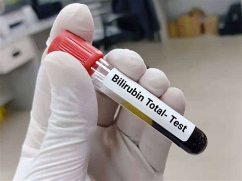 Diagnostic Services Bilirubin Total Test Other From Villupuram