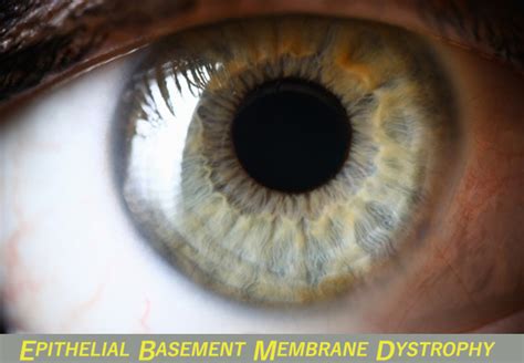 Epithelial Basement Membrane Dystrophy Prevention With Ayurveda