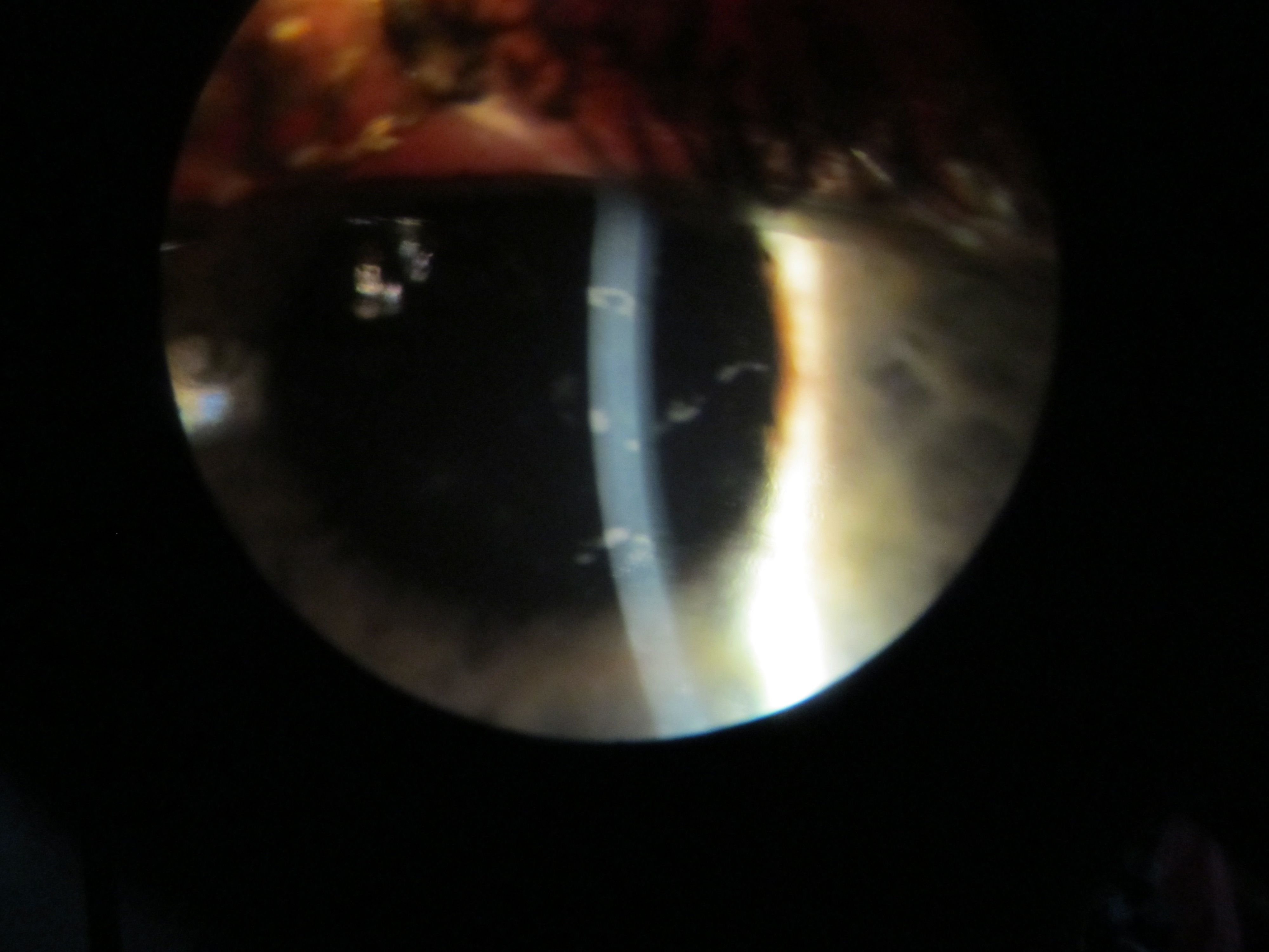 Epithelial Basement Membrane Dystrophy