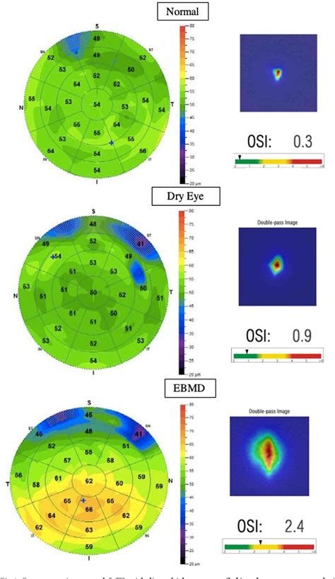 Figure 3 From Assessment Of Corneal Epithelial Thickness Mapping In