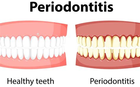 Healing Gum Diseases Naturally Scaling And Root Planing As A Holistic