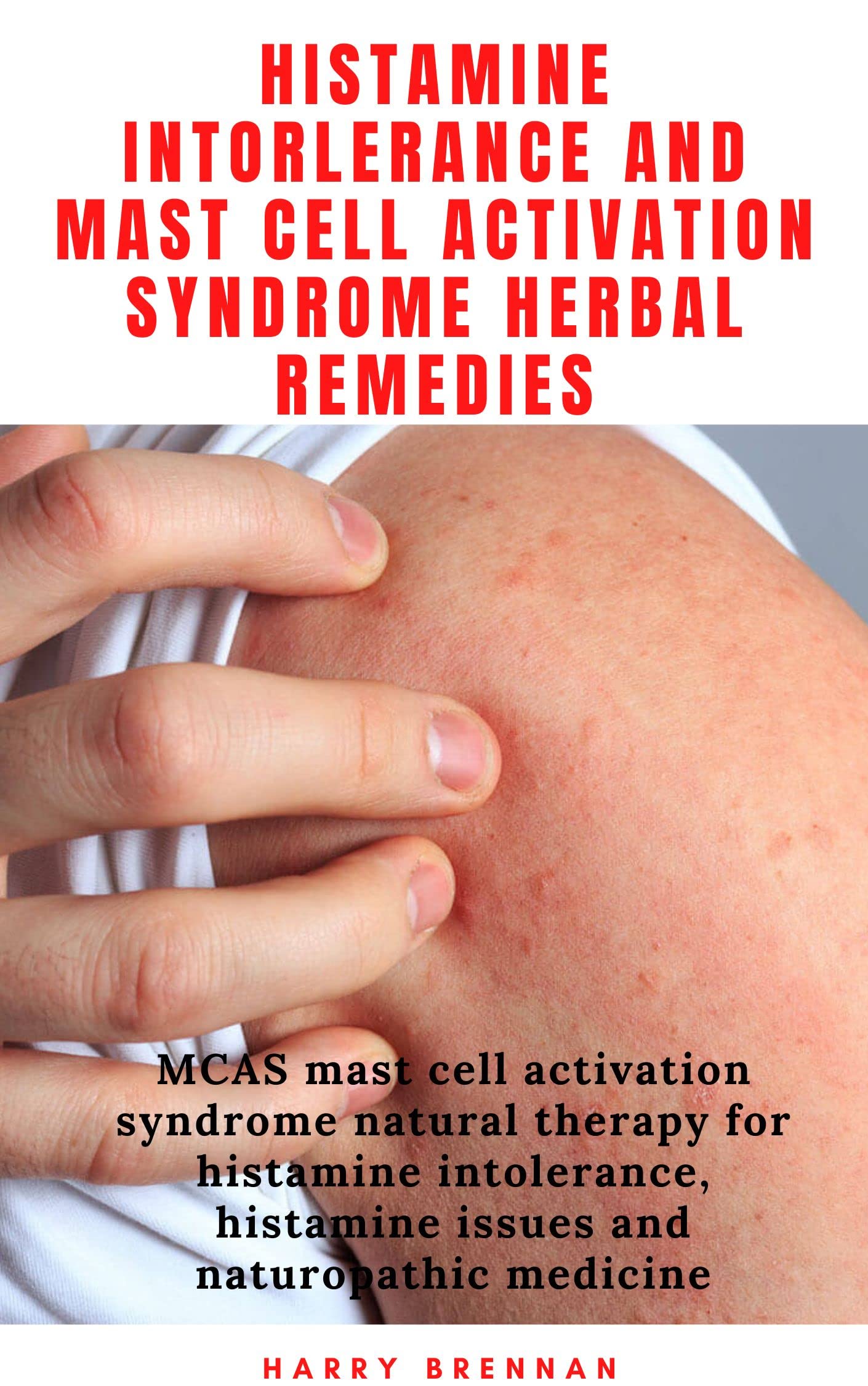 Histamine Intorlerance And Mast Cell Activation Syndrome Herbal