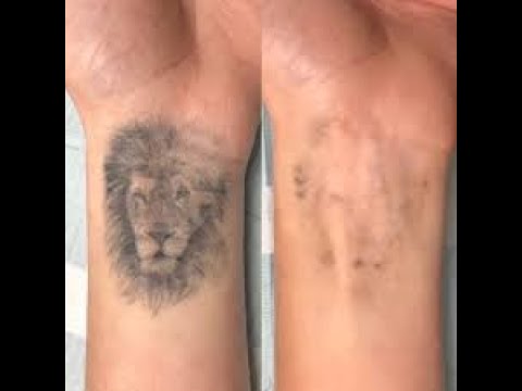 How To Remove Tattoo Naturally At Home Without Laser Youtube