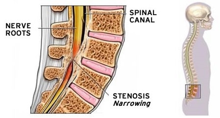 Icd 10 Spinal Stenosis Lumbar