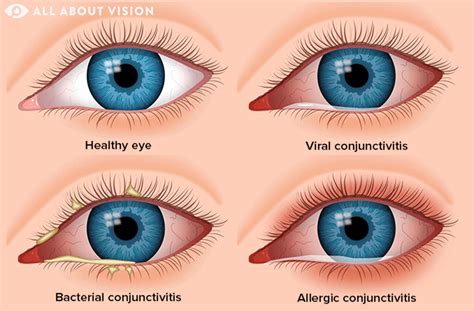 Iritis Vs Conjunctivitis