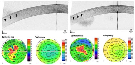 Jcm Free Full Text Acuity And Quality Of Vision In Eyes With