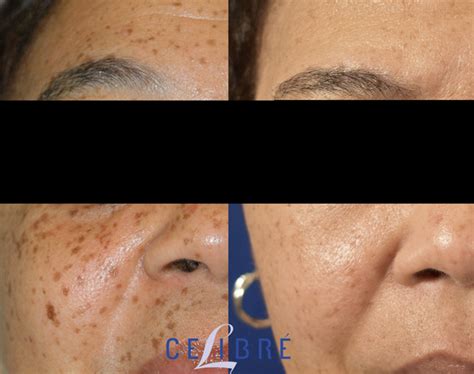 Laser Dark Spot Removal Artofit