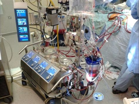 Life Expectancy After Ecmo