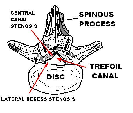 Lumbar Spinal Stenosis Wikipedia