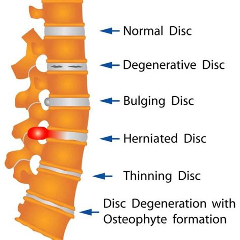 Lumbar Spondylosis Sun Orthopaedic