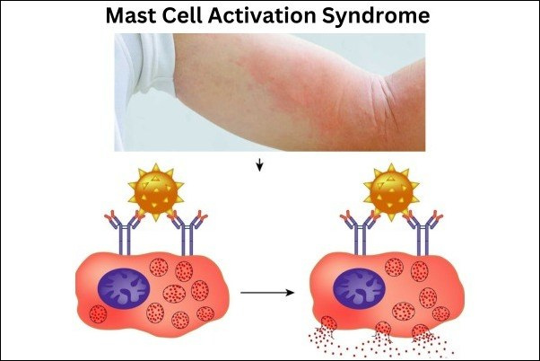 Mast Cell Activation Syndrome Treatment In Ayurveda