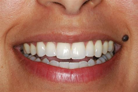 Perio Dentist Hopewell Junction Cosmetic Dentistry Hopewell Junction