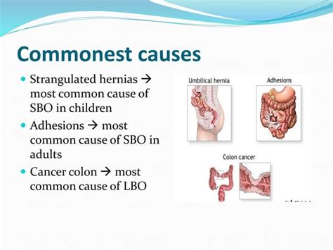 Pro's Guide: Drain Stomach Swelling Now