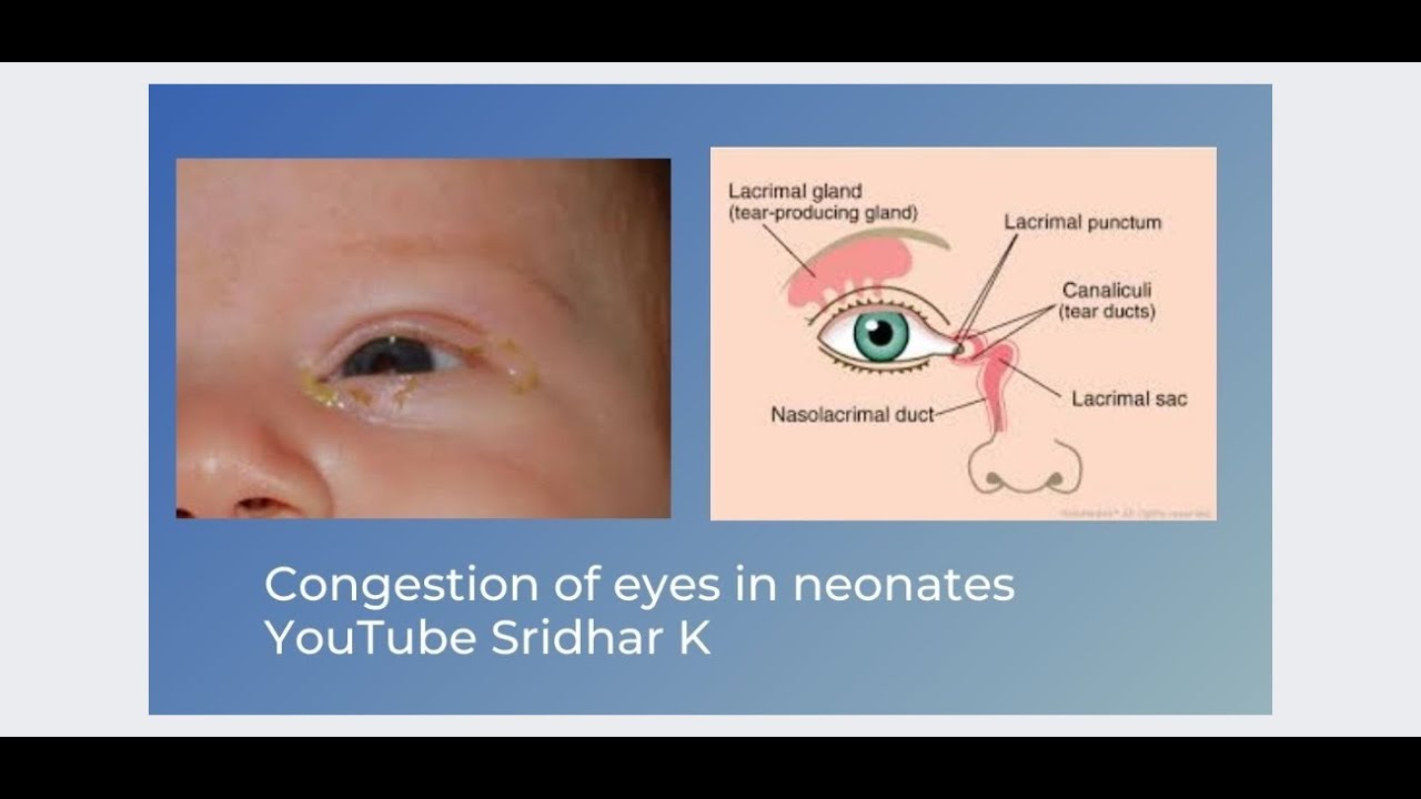 Quick Overview Of The Modified Ballard Score Dr Sridhar K Youtube