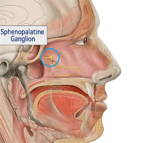 Sphenopalatine Ganglion Block