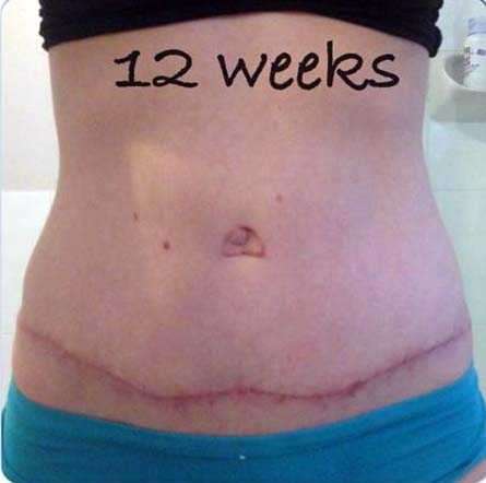 Swelling Is Normal After Getting A Tummy Tuck Check Out These 9 Little