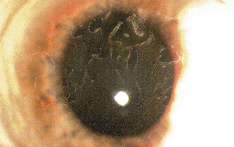 Treatment Of Epithelial Basement Membrane Dystrophy With Manual